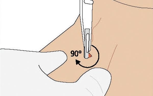 Grafische Darstellung der Drehung mit dem ScalpelCric Koniotomie Set