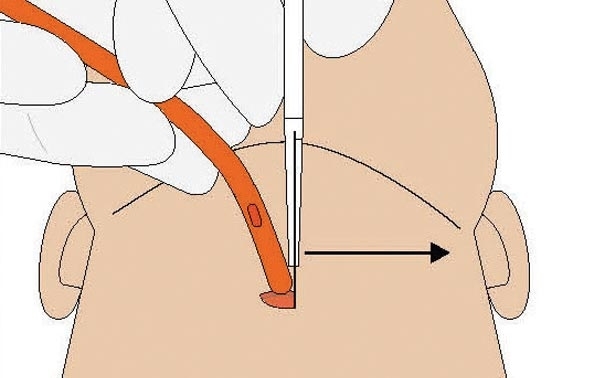 Grafische Darstellung des Bougie